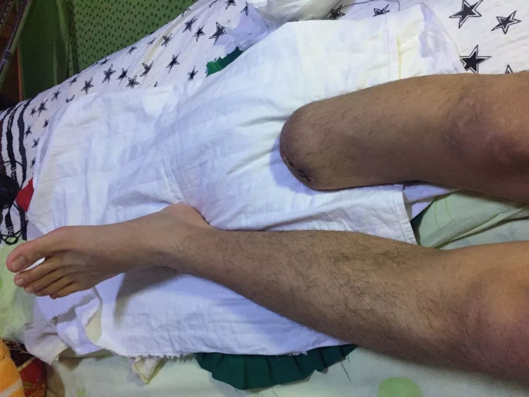 俄罗斯留学生骨折截肢,留学生意外被截肢