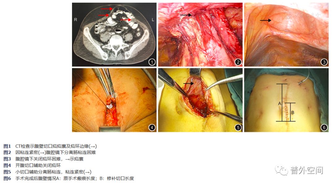 腹腔镜疝修补术中意外及处理策略,腹腔镜疝修补补片放哪
