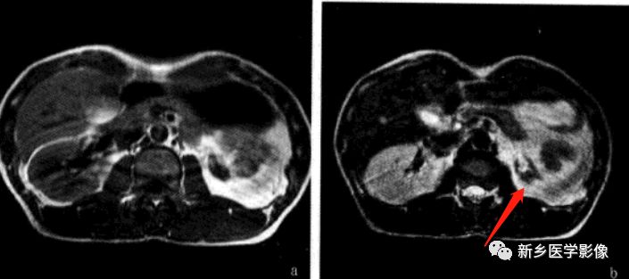 肾脏形态变异怎么办,肾脏疾病鉴别五项意义