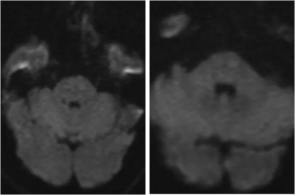 椎动脉v4段血管瘤介入治疗,臭氧治疗左侧v4段椎动脉狭窄