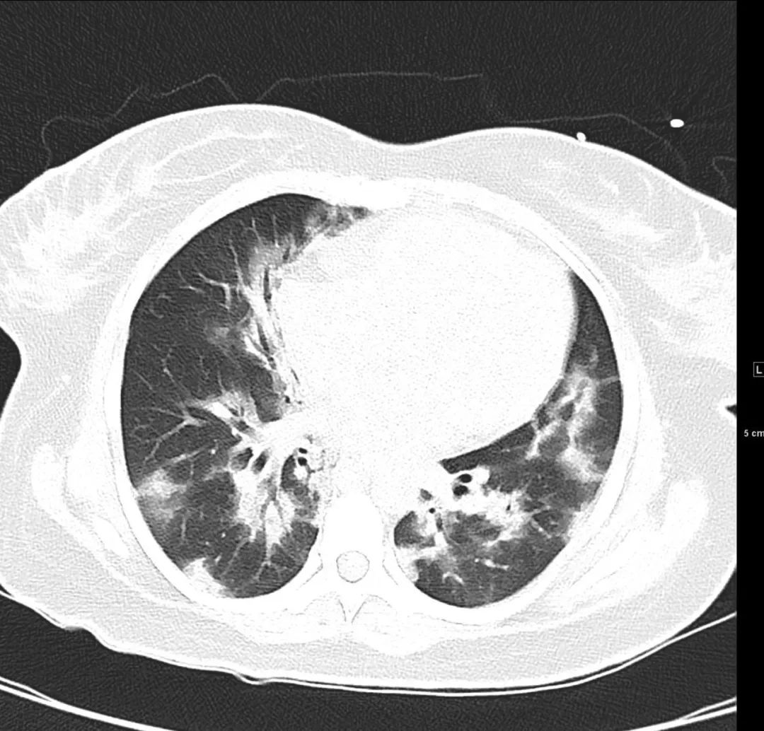 心冠动脉夹层能治愈吗,夹层动脉血管破裂症状