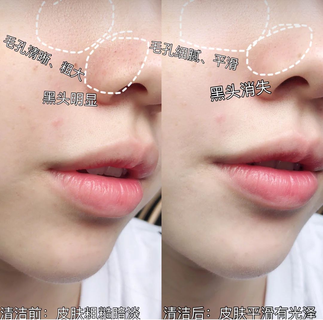 火山泥膜深层清洁面膜测评,嫩肤的白泥面膜评测