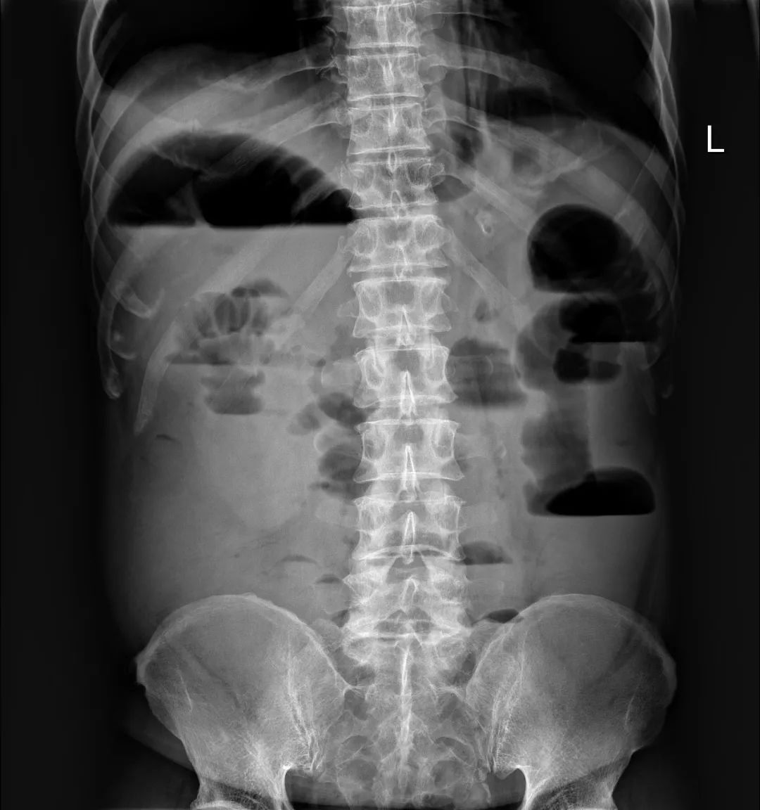消化道支架置入术,消化道梗阻支架怎么放
