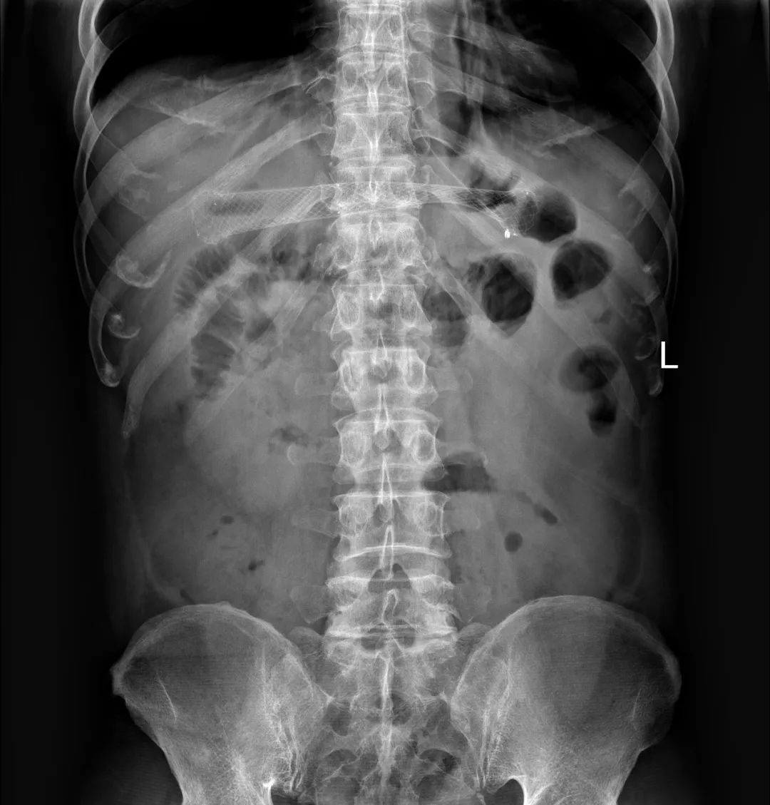 消化道支架置入术,消化道梗阻支架怎么放