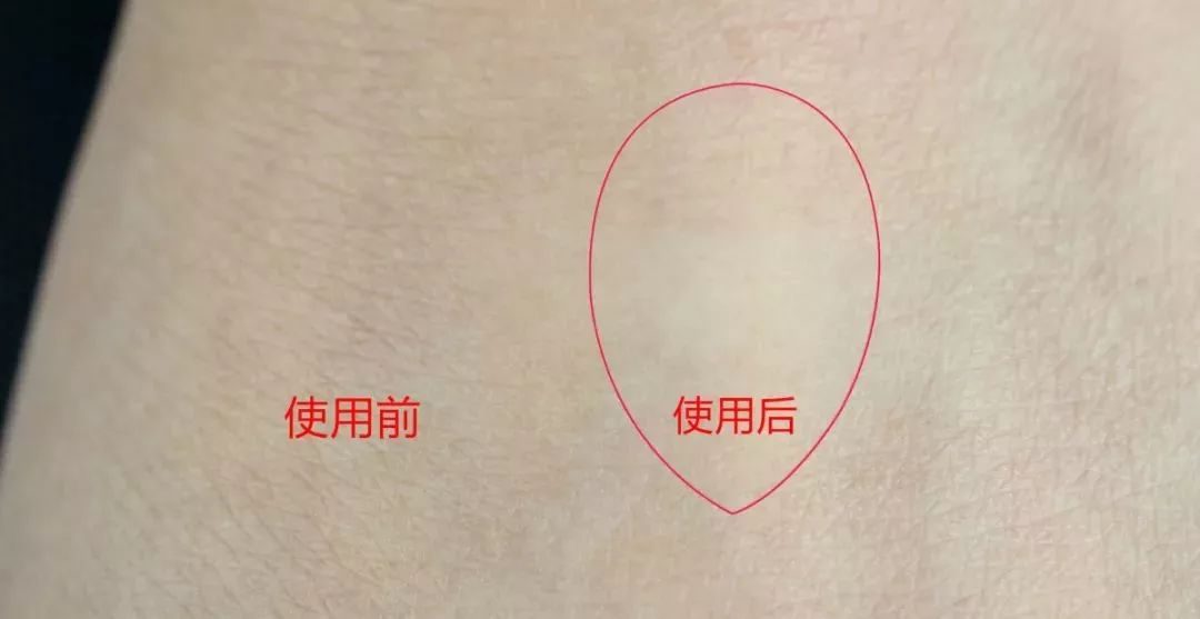 眉间纹抬头纹祛皱效果好吗,祛皱淡纹美容院