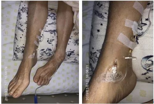 扎留置针有回血送针失败,留置针回血穿刺失败