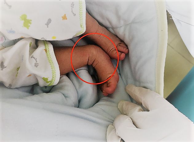 刚出生就要打石膏？硬核医生手工打造矫形器治疗足外翻