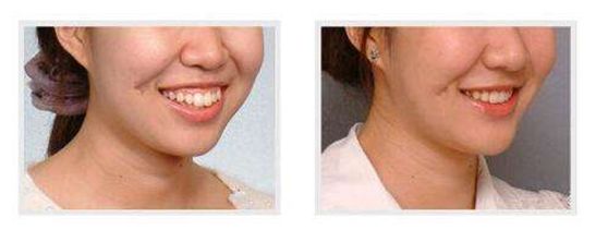 外用涂抹式肉毒素可以祛皱纹吗,去皱纹的肉毒素一年打几次为佳