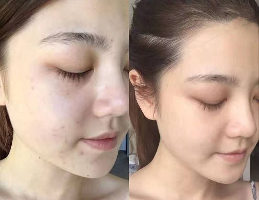 祛斑美白补水祛皱祛痘,祛斑祛痘美白改善暗沉