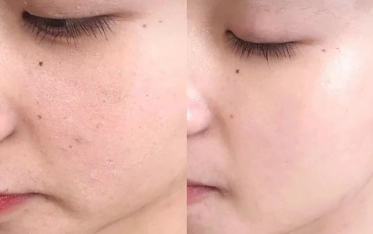 祛斑美白补水祛皱祛痘,祛斑祛痘美白改善暗沉