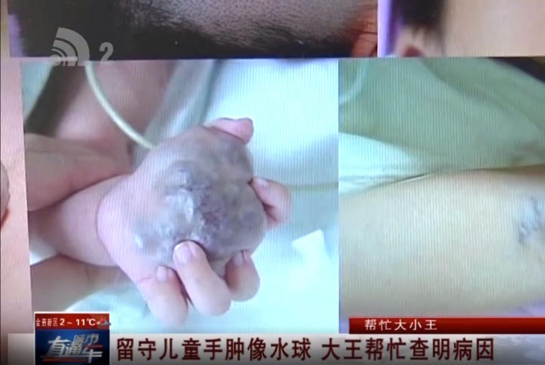 帮忙大小王|留守儿童手肿像水球大王帮忙查明病因