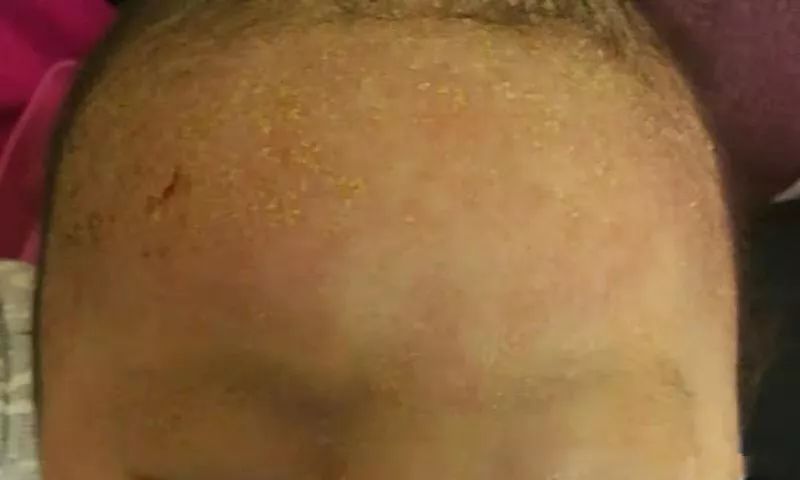 宝宝得了湿疹皮炎怎么办,婴儿特殊类型的湿疹以及皮炎