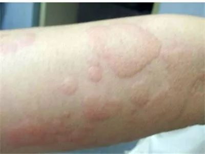 宝宝得了湿疹皮炎怎么办,婴儿特殊类型的湿疹以及皮炎