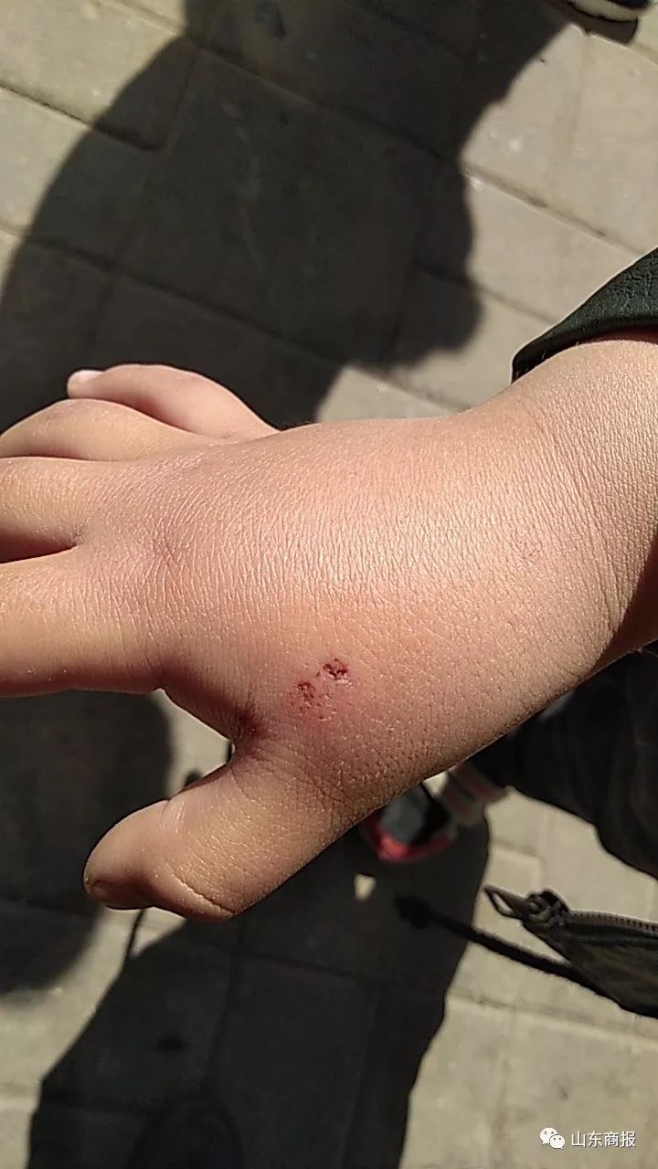 宠物鼠咬了要打疫苗吗,被宠物鼠咬了要打疫苗吗要打几针