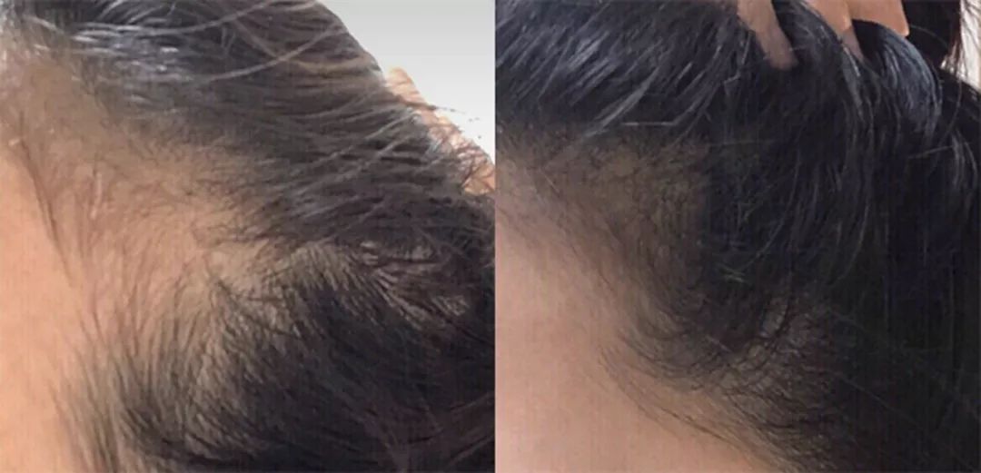 拯救发际线增加发量洗发水,生发发际线的神器测评