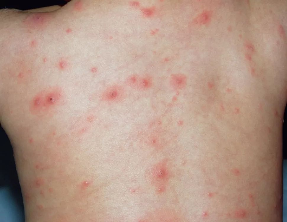 宝宝高烧后身上起疹子是怎么回事,宝宝高烧不退脸上有红点