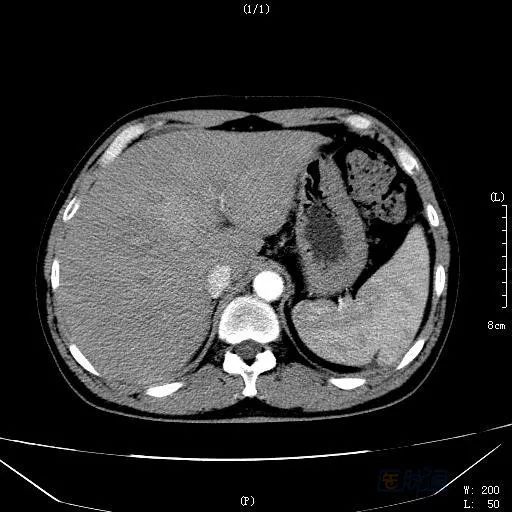 身边有肝癌治好的吗,治好肝癌全国首例