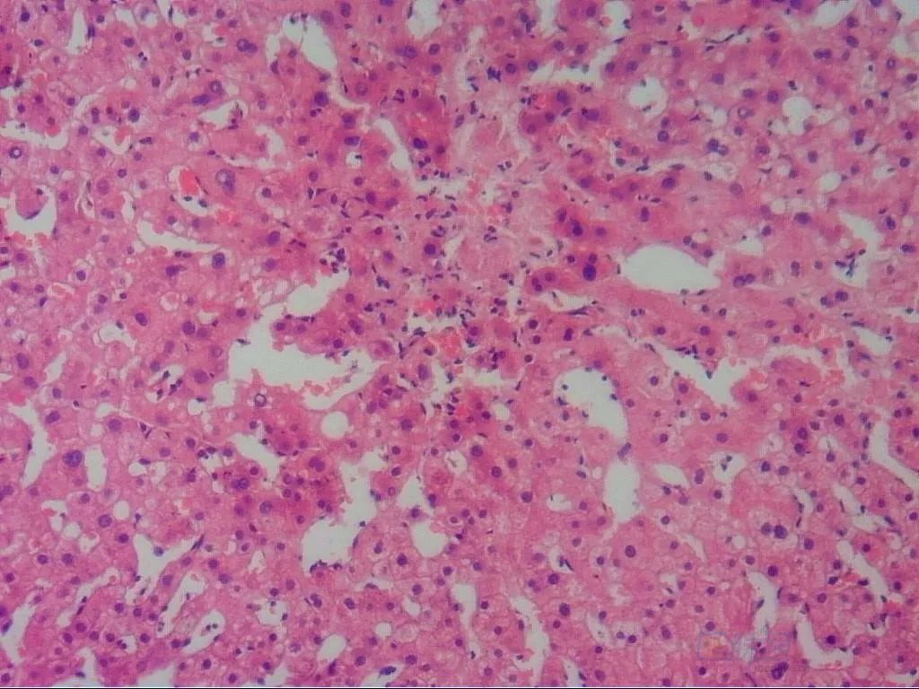 身边有肝癌治好的吗,治好肝癌全国首例