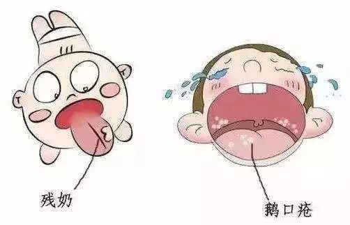 青岛妇幼治疗鹅口疮的药,妇幼治疗鹅口疮的药