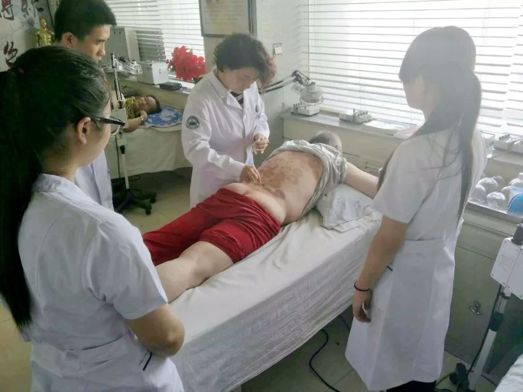 中医拔火罐治疗带状疱疹,带状疱疹中医称呼是什么