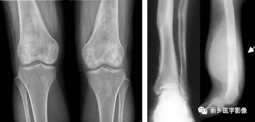 骨骼疾病怎么调理最有效,骨骼坏死最佳治疗方法