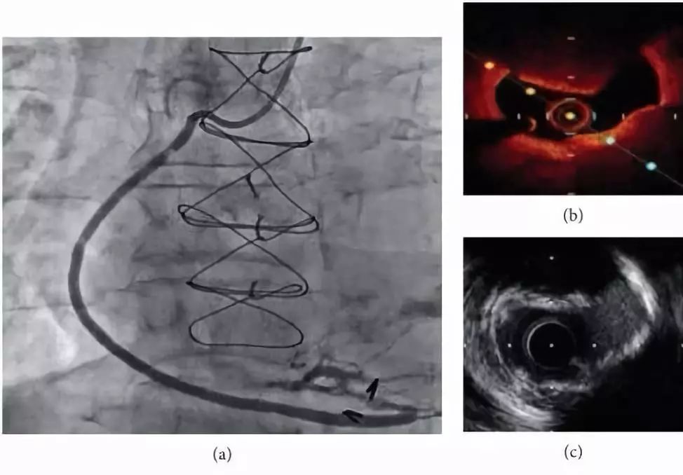 oct閽欏寲鐥呭彉,cit2019灞曚細瑙嗛