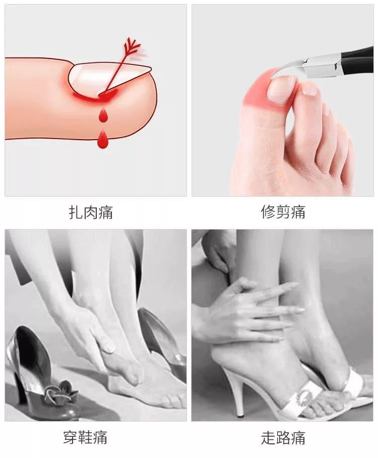 小脚趾甲长在肉里一碰就疼怎么办,指甲扎到肉里怎么处理