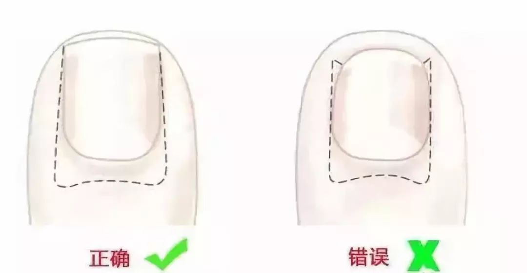 小脚趾甲长在肉里一碰就疼怎么办,指甲扎到肉里怎么处理