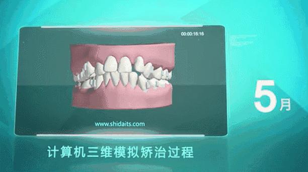 别人矫牙1万起,广州只要3960元!仅限2天