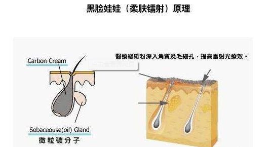 六大激光美容项目注意事项
