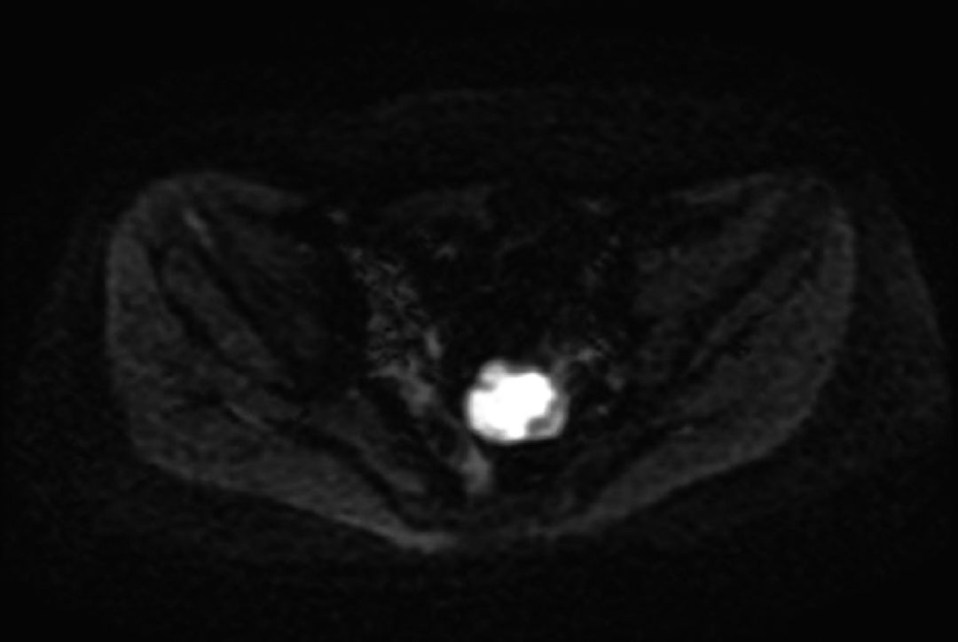 分子靶向治疗和基因靶向治疗,分子靶向治疗视频