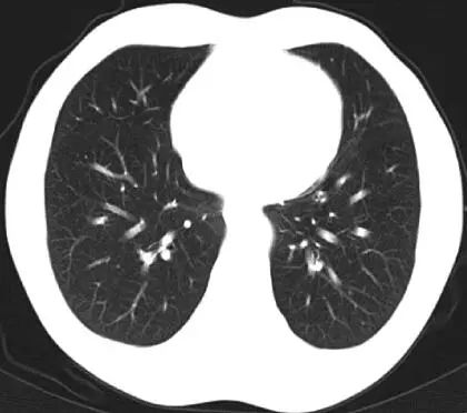 分子靶向治疗和基因靶向治疗,分子靶向治疗视频