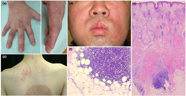 盘状红斑狼疮和皮肌炎哪个严重,皮肌炎合并系统性红斑狼疮