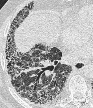 胸部解剖及常见疾病影像表现,胸部影像学基础知识