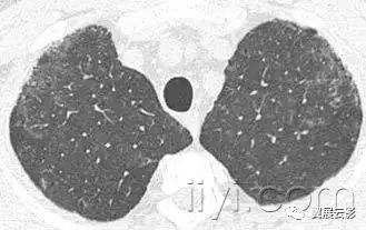 胸部解剖及常见疾病影像表现,胸部影像学基础知识