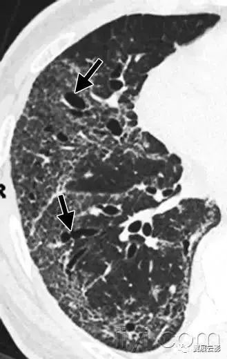 胸部解剖及常见疾病影像表现,胸部影像学基础知识