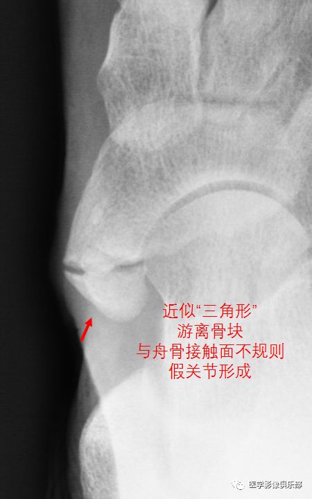 足副骨综合征,副舟骨疼痛综合征