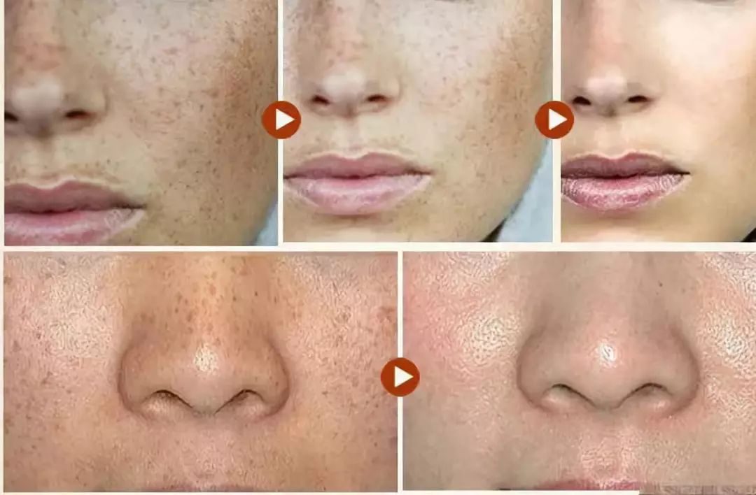 坚持7天的细纹消失,没有细纹但是有斑点