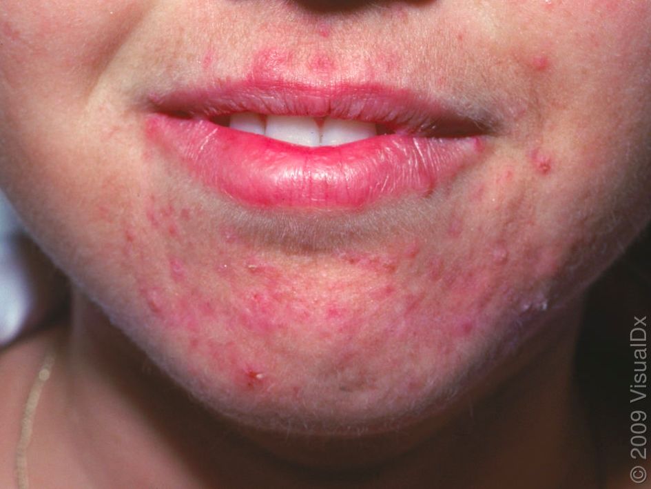 哪种皮肤病容易被误判为银屑病,容易被误诊为疥疮的皮肤病