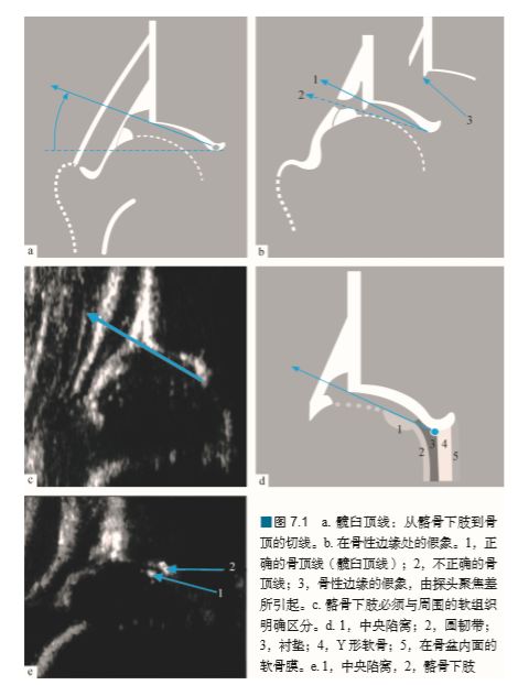 graf教授,graf法髋关节超声检查正常值