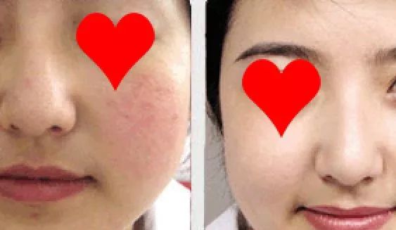 不用洗床单晒被子怎么除螨虫,螨虫去除妙招不用花露水