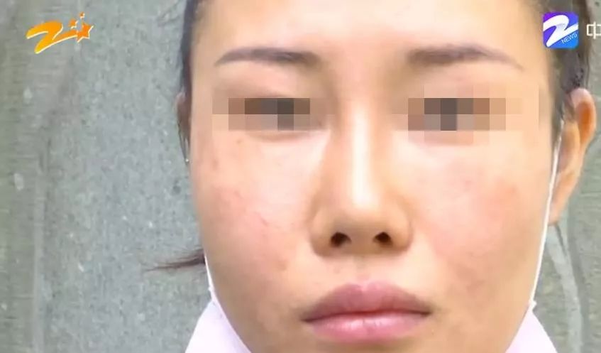 花四万元整形鼻子成了S型?
