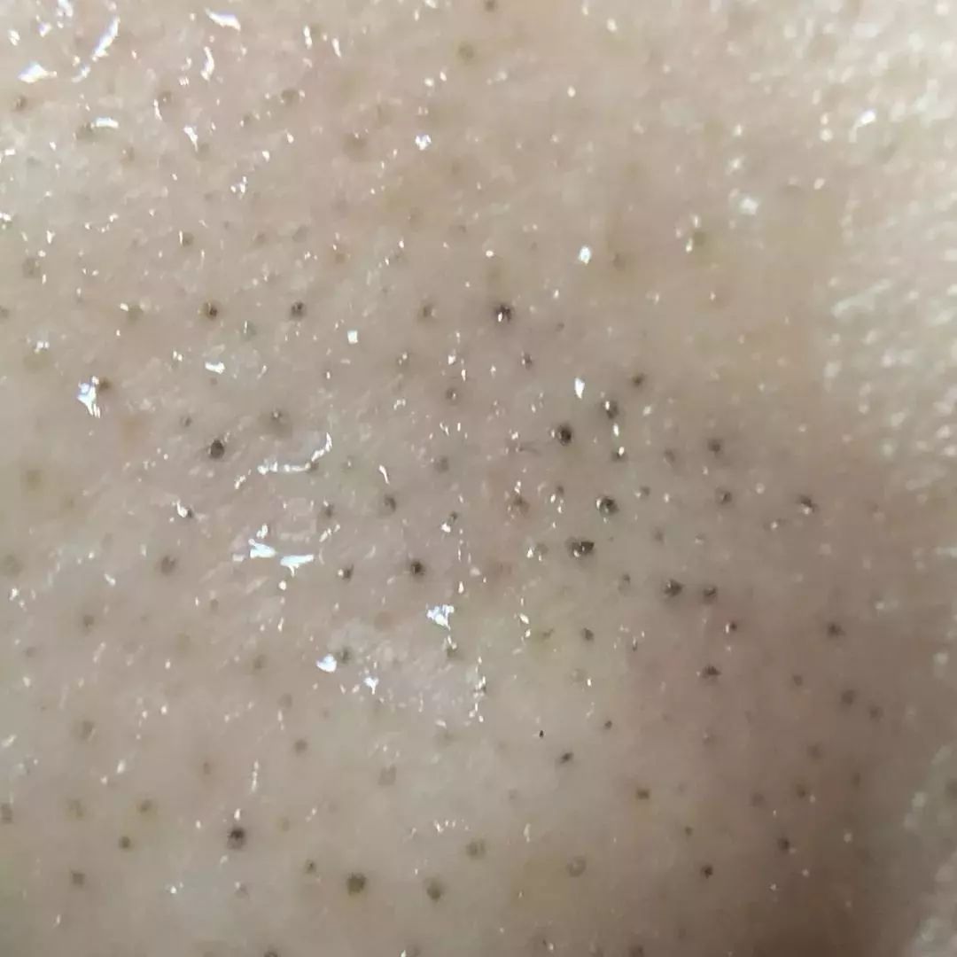 怎么把脸上的黑头清掉,去黑头推荐全脸