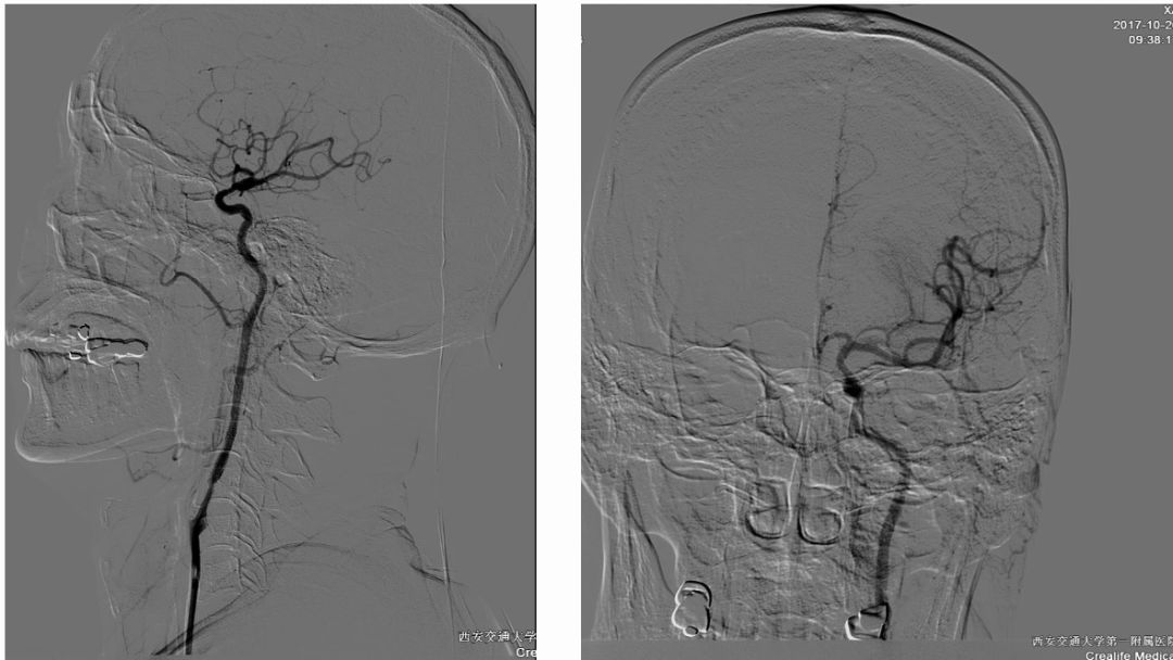 径技·例量|25期：再灌注出血—防不胜防