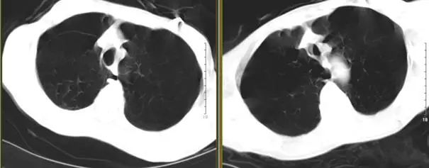 支气管镜热消融术治疗慢阻肺,西京医院支气管镜