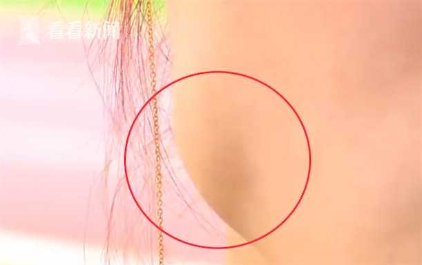 女子注射瘦脸针变成30岁的脸,注射瘦脸针后脸型变了