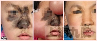 点黑痣后用什么修复最好,黑色素痣扩张术是什么原理