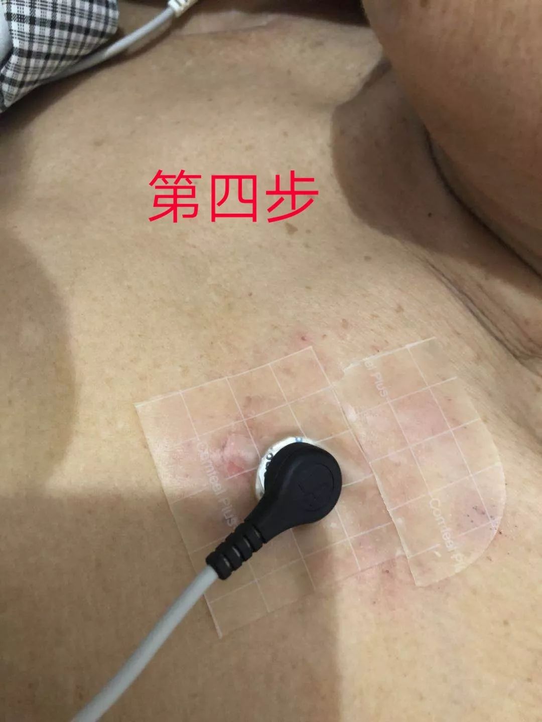 电极片皮试过敏,电极贴过敏的整改措施