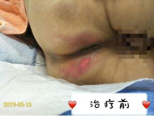 治疗特应性皮炎四步走,怎么快速抑制特应性皮炎的痒