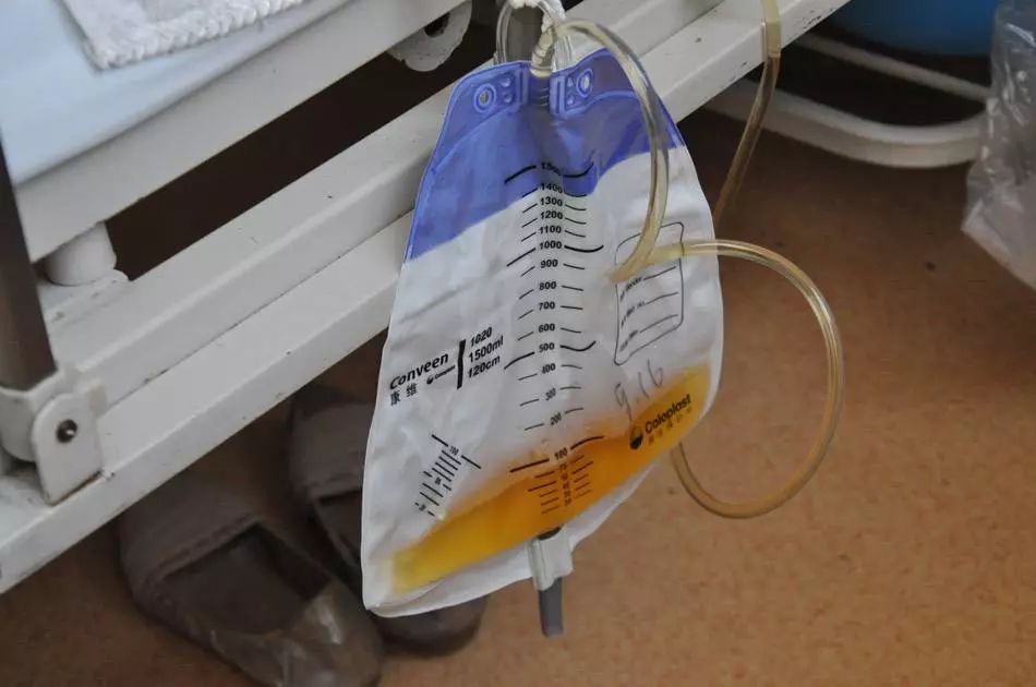 拔出尿管后排尿困难怎么回事,拔出尿管后患者不能正常排尿